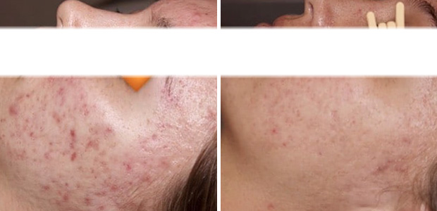 before and after acne therapy portland