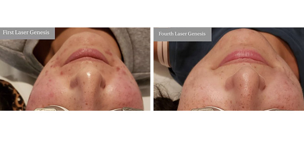Acne Therapy | Luxe Laser | Portland, Oregon Medical Spa