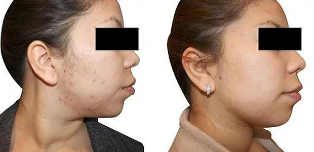 before and after acne therapy portland