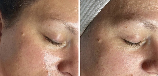 before and after hydrafacial portland