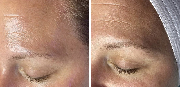 before and after hydrafacial portland