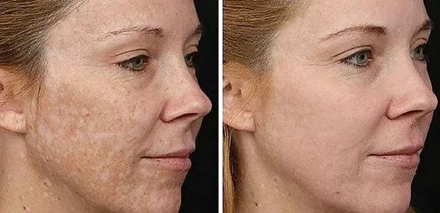 before and after ipl photofacial portland