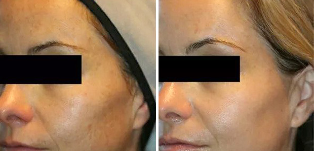 before and after ipl photofacial portland