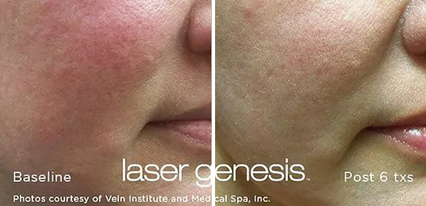 before and after laser genesis treatment portland