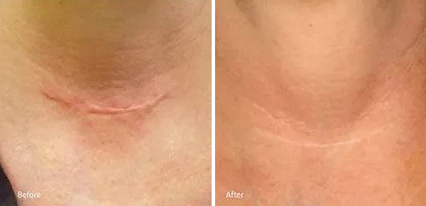 before and after laser genesis treatment portland