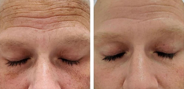 before and after microneedling portland