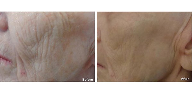 before and after microneedling portland