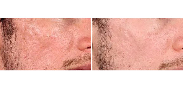 before and after skin resurfacing portland