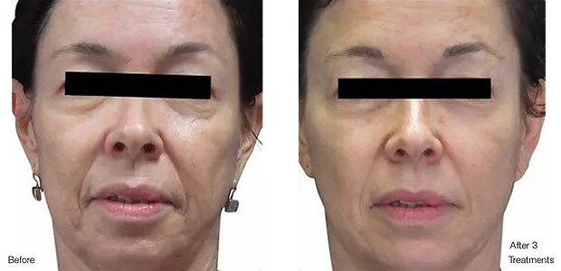 before and after skin resurfacing portland