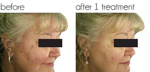 before and after tribella treatment portland
