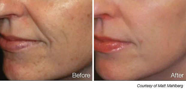 before and after tribella treatment portland