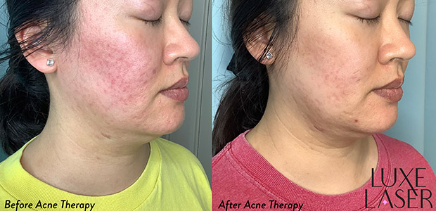 acne therapy amy chan
