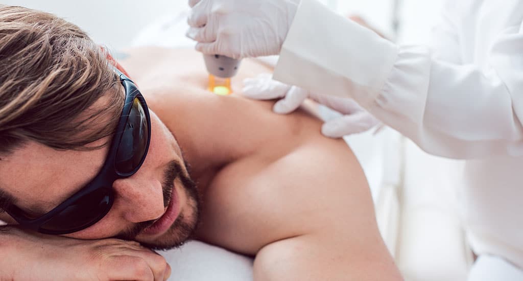 male laser hair removal